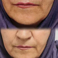 ژل خط خنده ( شوش)|خدمات آرایشگری و زیبایی|شوش, |دیوار