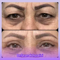 تخفیف تزریق ژل بوتاکس لیفت نخ هایفو فیلرلب لیزر|خدمات آرایشگری و زیبایی|تهران, سعادت‌آباد|دیوار