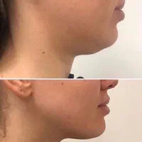 هایفوتراپی جوانسازی لیفت صورت غبغب آف به مدت محدود|خدمات آرایشگری و زیبایی|قم, شهرک قدس|دیوار