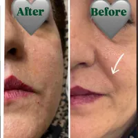 مطب تخفیف ژل و فیلر لب و صورت و بوتاکس|خدمات آرایشگری و زیبایی|قم, صفائیه|دیوار