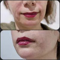افر ویژه‌ی فیلر/بوتاکس/prpبا قیمت باورنکردنی|خدمات آرایشگری و زیبایی|تهران, دروازه شمیران|دیوار