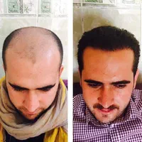 مرکز کاشت مو آتیه یزد|خدمات آرایشگری و زیبایی|یزد, |دیوار