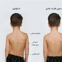 مرکز ارتوپدی درمان غیرجراحی انحراف ستون فقرات