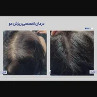 ۸۰درصد تخفیف در/لیزر/مزوتراپی/prp/جوانساز|خدمات آرایشگری و زیبایی|اندیشه, اندیشه فاز ۴|دیوار