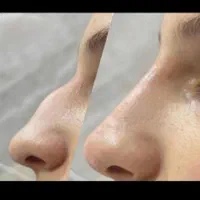 مطب ژل وبوتاکس لب لیفت با نخ رفع گودی چشم جدید|خدمات آرایشگری و زیبایی|گرگان, |دیوار