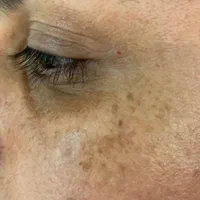 آموزش تخصصی کرم پودرفشیال مزونیدل اسکالپ سر وخدمات|خدمات آرایشگری و زیبایی|مشهد, جانباز|دیوار