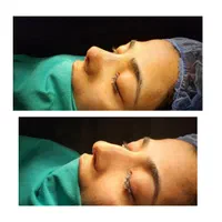 عمل زیبایی بینی(شوش)