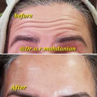 بوتاکس ژل فیلر مزوتراپی لیزر هایفو لیفت نخ در مطب|خدمات آرایشگری و زیبایی|اصفهان, مسجد مصلی|دیوار