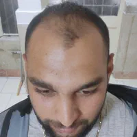 جشنواره کاشت مو و مزوتراپی