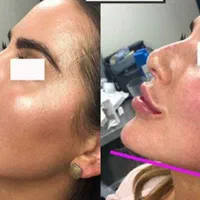 تزریق ژل و بوتاکس و کاشت نخ در کلینیک زیبایی|خدمات آرایشگری و زیبایی|خرم‌آباد, |دیوار