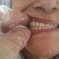 دندان مصنوعی متحرک (تحویل ۳ روزه)|خدمات آرایشگری و زیبایی|کرمانشاه, |دیوار