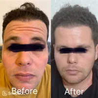 کاشت مو و ابرو و انجام بوتاکس و مزوتراپی و PRP|خدمات آرایشگری و زیبایی|قزوین, |دیوار