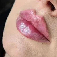 لیزر مو ژل لب بوتاکس هایفوتراپی دکتر سلطانی