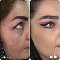 ژل بوتاکس،بلفاروپلاستی،پی آر پی،فیشیال ساکشن غبغب|خدمات آرایشگری و زیبایی|تبریز, |دیوار