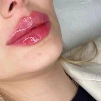ژل لب فیلر بوتاکس لیزر مو هایفو پی آرپی خال برداری|خدمات آرایشگری و زیبایی|مشهد, آزادشهر|دیوار