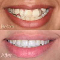 ارتودنسی ثابت ومتحرک|خدمات آرایشگری و زیبایی|شیراز, قصرالدشت|دیوار
