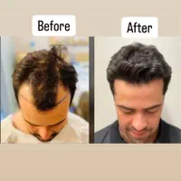 کاشت مو و ابرو و انجام بوتاکس و مزوتراپی و PRP|خدمات آرایشگری و زیبایی|قزوین, |دیوار