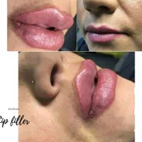 آموزش نخ و تزریق ژل و بوتاکس و مزوژل در مطب