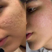 کلینیک پوست/درمان لک/جوش جای جوش/مزونیدلینگ/فشیال|خدمات آرایشگری و زیبایی|مشهد, فرهنگ|دیوار