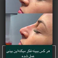 ژل لب روسی وعروسکی از ۸۰۰ ،بوتاکس۷۰۰ پی ارپی۷۰۰|خدمات آرایشگری و زیبایی|مشهد, فلسطین|دیوار