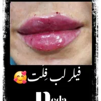 سابسیژن فیلر اندولیفت ژل بادی هایفو مزو بوتاکس|خدمات آرایشگری و زیبایی|کرج, مهرویلا جنوبی|دیوار