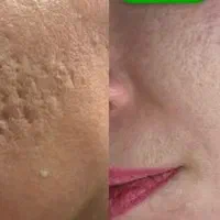 کلینیک پوست/درمان لک/جوش جای جوش/مزونیدلینگ/فشیال|خدمات آرایشگری و زیبایی|مشهد, فرهنگ|دیوار