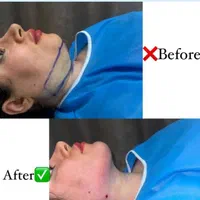 تزریق چربی فیلربادی تزریق ژل در مطب پزشک