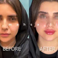 دکتر متخصص تزریق ژل لب روسی فیلر بینی زاویه پزشک|خدمات آرایشگری و زیبایی|تهران, پونک|دیوار