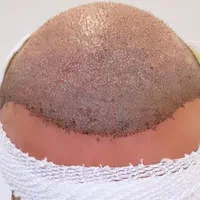کاشت مو،ابرو،ریش فوق تخصصی باتراکم بالا|خدمات آرایشگری و زیبایی|شیراز, ستارخان|دیوار