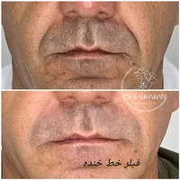 مرکز لیزر و زیبایی دکتر کیانی/ ژل بوتاکس مزو|خدمات آرایشگری و زیبایی|اهواز, کوروش|دیوار
