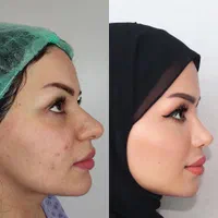 عمل جراحی زیبایی بینی ۲۴ میلیون  رینو بلفارو لیپو|خدمات آرایشگری و زیبایی|تهران, میدان ولیعصر|دیوار