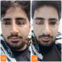 تزریق آنزیم بینی/فیلر بینی/شقیقه/ژل/درکلینیک پزشکی|خدمات آرایشگری و زیبایی|شیراز, زرهی|دیوار