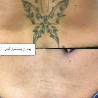 لیزرمو زائد/ریمو تتو/پاک کردن تتو/کیوسوئیچ/prp|خدمات آرایشگری و زیبایی|اصفهان, ملک|دیوار