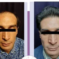 کاشت مو پرتراکم اقساطی با پرداخت 4میلیون تومان|خدمات آرایشگری و زیبایی|اصفهان, میرعماد|دیوار