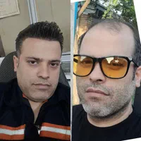 کاشت مو و ابرو با بروز ترین متد کاشت (تبریز)
