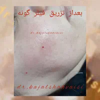 تزریق تخصصی ژل بوتاکس و جوانساز در مطب خانم دکتر|خدمات آرایشگری و زیبایی|سنندج, |دیوار