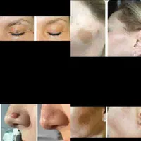 برداشتن انواع خال لک زیگیل تناسلی و...