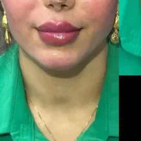 تخفیف فیلر صورت|خدمات آرایشگری و زیبایی|اهواز, زیتون کارمندی|دیوار