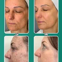 لیزر مو حتی کرکی ، لیزر انواع تتو ،لیزر سفیدکننده|خدمات آرایشگری و زیبایی|ایلام, |دیوار