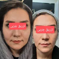 تزریق ژل وبوتاکس و لیزر موی زایدولیزر پاک کردن تتو|خدمات آرایشگری و زیبایی|نسیم‌شهر, |دیوار