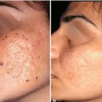 رفع جای جوش و پوست پرتقالی