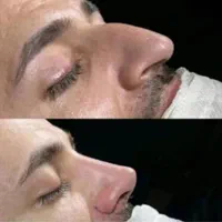 عمل بینی اف ۳روزه|خدمات آرایشگری و زیبایی|اهواز, کیانپارس |دیوار