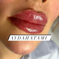 اف تزریق ژل و بوتاکس توسط کادر درمان در کلینیک|خدمات آرایشگری و زیبایی|اهواز, پادادشهر|دیوار