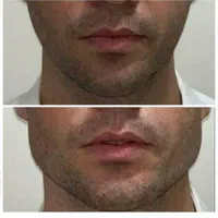 تزریق ژل و بوتاکس در تمام ایام حتی روزهای تعطیل|خدمات آرایشگری و زیبایی|فردیس, |دیوار
