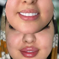 تزریق ژل و بوتاکس تخفیف بهاره ۳۹۹|خدمات آرایشگری و زیبایی|تهران, نازی‌آباد|دیوار