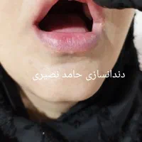 دندان مصنوعی دندانسازی حامد نصیری|خدمات آرایشگری و زیبایی|خرمآباد, |دیوار