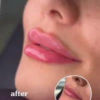 تزریق ژل و بوتاکس تخفیف  عیدانه۳۹۹|خدمات آرایشگری و زیبایی|تهران, عبدل‌آباد|دیوار