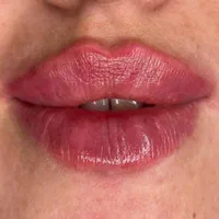 تزریق ژل و بوتاکس تمام ایام حتی روزهای تعطیل