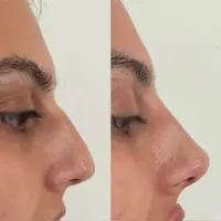 آنزیم ترکیبی بینی گوشتی،لیفت بینی،ژل لب،مزوتراپی|خدمات آرایشگری و زیبایی|تهران, سعادت‌آباد|دیوار