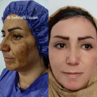 درمان لک وجای جوش